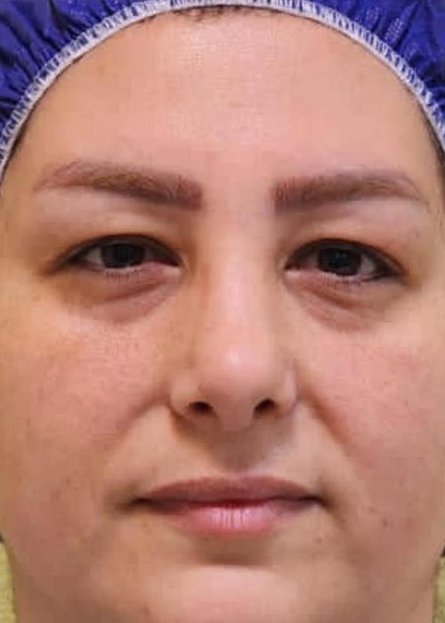 قبل از بلفاروپلاستی