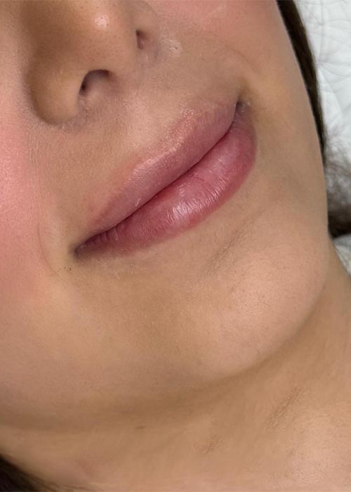 قبل از فیلر لب