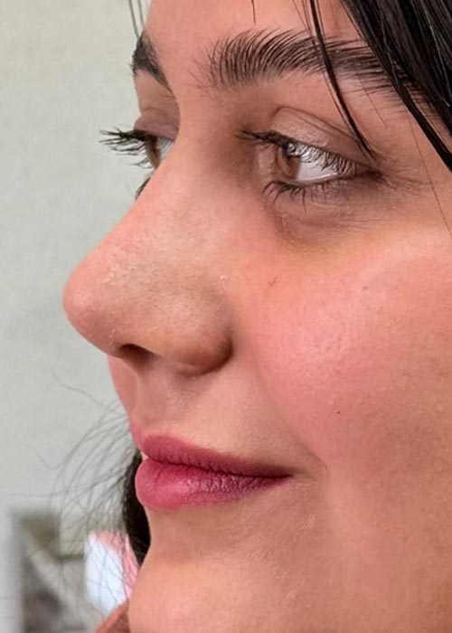 بعد از جراحی بینی