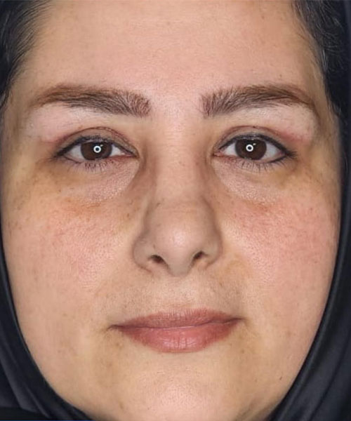 بعد از بلفاروپلاستی فوقانی