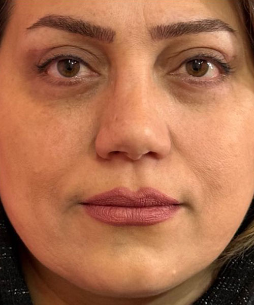 بعد از جراحی ترکیبی دور چشم