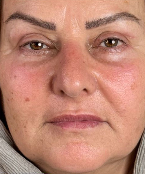 بعد از جوانسازی چهارطرفه چشم