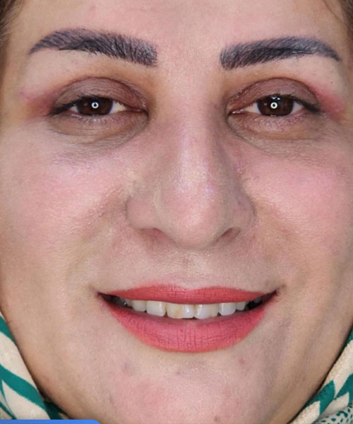 بعد از لیفت پلک با چربی