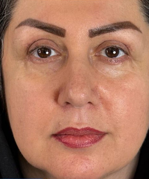 بعد از جراحی ترکیبی