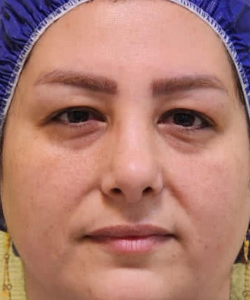 قبل از بلفاروپلاستی فوقانی