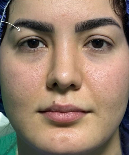 قبل از لیفت آندوسکوپیک شقیقه